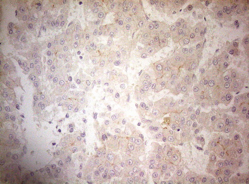 OSGIN2 Antibody - Immunohistochemical staining of paraffin-embedded Carcinoma of Human liver tissue using anti-OSGIN2 mouse monoclonal antibody. (Heat-induced epitope retrieval by 1mM EDTA in 10mM Tris buffer. (pH8.5) at 120°C for 3 min. (1:150)