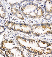 OSM / Oncostatin M Antibody - OSM / Oncostatin M antibody. IHC(P): Human Intestinal Cancer Tissue.