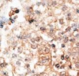 Osteocalcin Antibody - Formalin-fixed and paraffin-embedded human cancer tissue reacted with the primary antibody, which was peroxidase-conjugated to the secondary antibody, followed by DAB staining. This data demonstrates the use of this antibody for immunohistochemistry; clinical relevance has not been evaluated. BC = breast carcinoma; HC = hepatocarcinoma.
