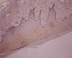 Osteocalcin Antibody - Synovial Sarcoma