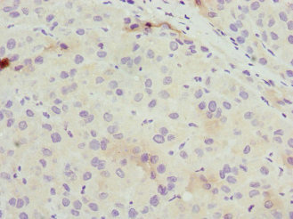 Osteocalcin Antibody - Immunohistochemistry of paraffin-embedded human liver cancer using BGLAP Antibody at dilution of 1:100