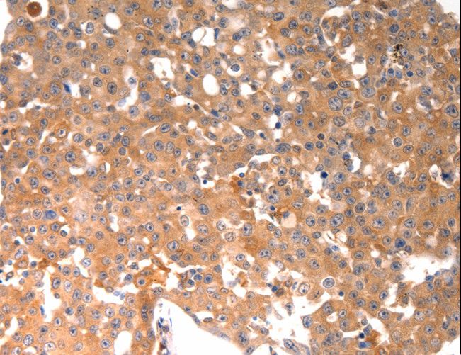Osteocalcin Antibody - Immunohistochemistry of paraffin-embedded Human ovarian cancer using BGLAP Polyclonal Antibody at dilution of 1:40.