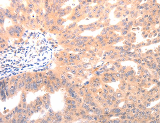 Osteocalcin Antibody - Immunohistochemistry of paraffin-embedded Human ovarian cancer using BGLAP Polyclonal Antibody at dilution of 1:40.