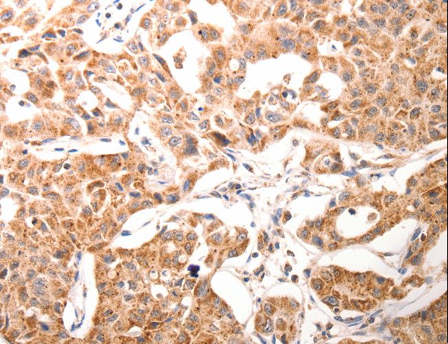 Osteocalcin Antibody - Immunohistochemistry of paraffin-embedded Human lung cancer using BGLAP Polyclonal Antibody at dilution of 1:60.