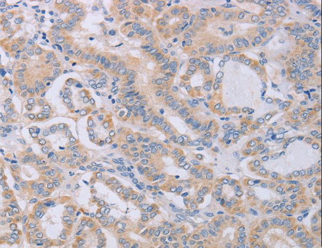 Osteocalcin Antibody - Immunohistochemistry of paraffin-embedded Human thyroid cancer using BGLAP Polyclonal Antibody at dilution of 1:40.