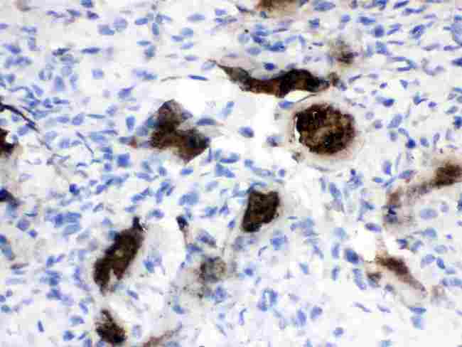 Osteocalcin Antibody - Osteocalcin was detected in paraffin-embedded sections of human osteosarcoma tissues using rabbit anti-Osteocalcin Antigen Affinity purified polyclonal antibod