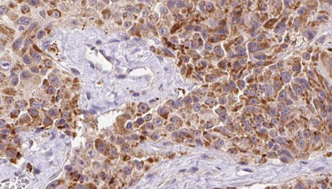 Osteocalcin Antibody - 1:100 staining human Melanoma tissue by IHC-P. The sample was formaldehyde fixed and a heat mediated antigen retrieval step in citrate buffer was performed. The sample was then blocked and incubated with the antibody for 1.5 hours at 22°C. An HRP conjugated goat anti-rabbit antibody was used as the secondary.