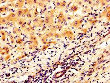 Osteoglycin / Mimecan Antibody - IHC image of OGN Antibody diluted at 1:300 and staining in paraffin-embedded human liver cancer performed on a Leica BondTM system. After dewaxing and hydration, antigen retrieval was mediated by high pressure in a citrate buffer (pH 6.0). Section was blocked with 10% normal goat serum 30min at RT. Then primary antibody (1% BSA) was incubated at 4°C overnight. The primary is detected by a biotinylated secondary antibody and visualized using an HRP conjugated SP system.