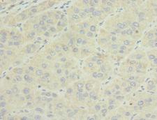 Osteoglycin / Mimecan Antibody - Immunohistochemistry of paraffin-embedded human liver cancer at dilution 1:100