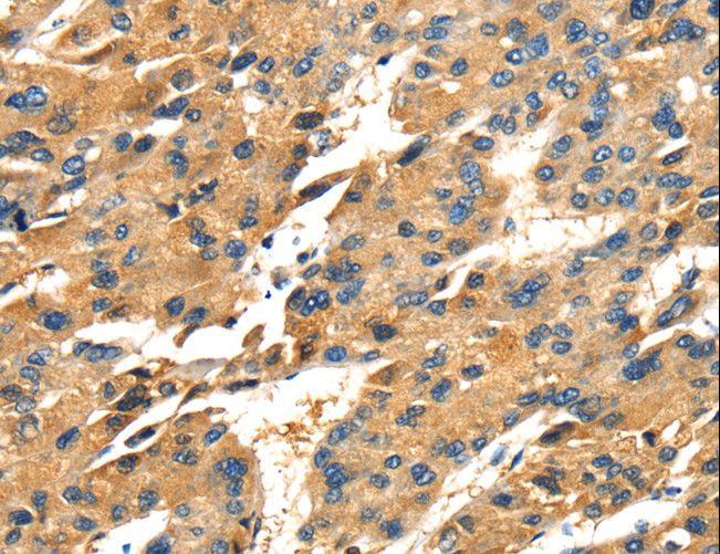 Osteonectin / SPARC Antibody - Immunohistochemistry of paraffin-embedded Human liver cancer using SPARC Polyclonal Antibody at dilution of 1:25.