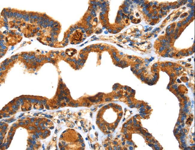 Osteonectin / SPARC Antibody - Immunohistochemistry of paraffin-embedded Human thyroid cancer using SPARC Polyclonal Antibody at dilution of 1:25.