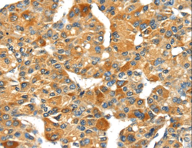 Osteonectin / SPARC Antibody - Immunohistochemistry of paraffin-embedded Human liver cancer using SPARC Polyclonal Antibody at dilution of 1:35.