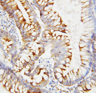 Osteonectin / SPARC Antibody - Osteonectin / SPARC antibody. IHC(P): Human Intestinal Cancer Tissue.