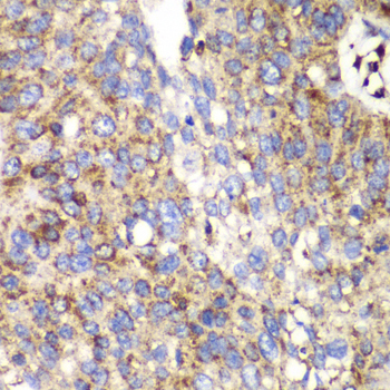 Osteonectin / SPARC Antibody - Immunohistochemistry of paraffin-embedded human lung cancer using SPARC antibodyat dilution of 1:100 (40x lens).