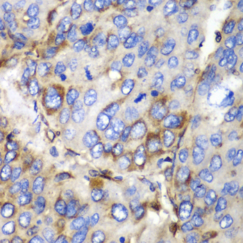 Osteonectin / SPARC Antibody - Immunohistochemistry of paraffin-embedded human liver cancer using SPARC antibodyat dilution of 1:100 (40x lens).