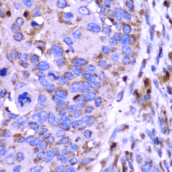 Osteonectin / SPARC Antibody - Immunohistochemistry of paraffin-embedded human esophageal cancer using SPARC antibodyat dilution of 1:100 (40x lens).