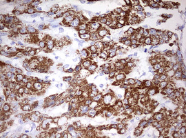 OTC Antibody - IHC of paraffin-embedded Carcinoma of Human liver tissue using anti-OTC mouse monoclonal antibody. (Heat-induced epitope retrieval by 10mM citric buffer, pH6.0, 120°C for 3min).