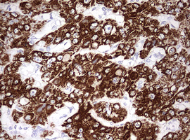 OTC Antibody - IHC of paraffin-embedded Carcinoma of Human liver tissue using anti-OTC mouse monoclonal antibody. (Heat-induced epitope retrieval by 10mM citric buffer, pH6.0, 120°C for 3min).