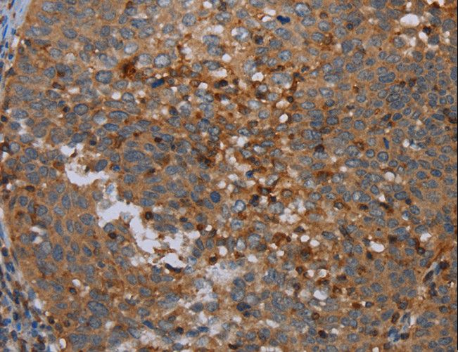 OTOR / Otoraplin Antibody - Immunohistochemistry of paraffin-embedded Human ovarian cancer using OTOR Polyclonal Antibody at dilution of 1:30.