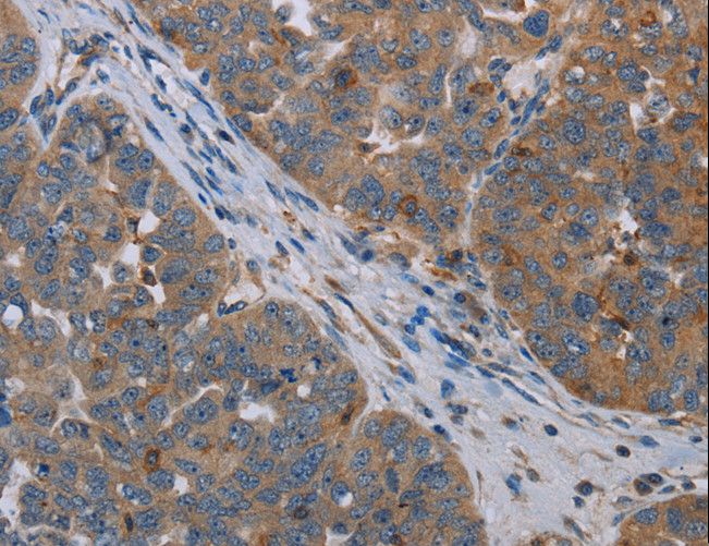 OTOR / Otoraplin Antibody - Immunohistochemistry of paraffin-embedded Human ovarian cancer using OTOR Polyclonal Antibody at dilution of 1:30.