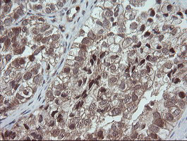 OTUB1 / OTU1 Antibody - IHC of paraffin-embedded Adenocarcinoma of Human ovary tissue using anti-OTUB1 mouse monoclonal antibody. (Heat-induced epitope retrieval by 10mM citric buffer, pH6.0, 100C for 10min).