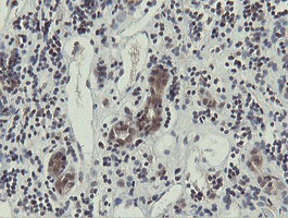 OTUB1 / OTU1 Antibody - IHC of paraffin-embedded Carcinoma of Human kidney tissue using anti-OTUB1 mouse monoclonal antibody.