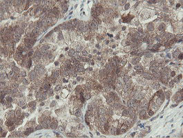 OTUB1 / OTU1 Antibody - IHC of paraffin-embedded Adenocarcinoma of Human ovary tissue using anti-OTUB1 mouse monoclonal antibody.