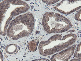 OTUB1 / OTU1 Antibody - IHC of paraffin-embedded Carcinoma of Human prostate tissue using anti-OTUB1 mouse monoclonal antibody.