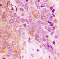 OTUB1 / OTU1 Antibody - Immunohistochemical analysis of OUTB1 staining in human breast cancer formalin fixed paraffin embedded tissue section. The section was pre-treated using heat mediated antigen retrieval with sodium citrate buffer (pH 6.0). The section was then incubated with the antibody at room temperature and detected using an HRP conjugated compact polymer system. DAB was used as the chromogen. The section was then counterstained with haematoxylin and mounted with DPX.