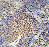OTUD4 Antibody - OTUD4 antibody immunohistochemistry of formalin-fixed and paraffin-embedded human lung carcinoma followed by peroxidase-conjugated secondary antibody and DAB staining.