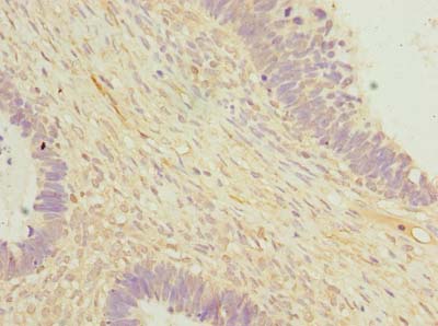 OTUD6B Antibody - Immunohistochemistry of paraffin-embedded human ovarian cancer using antibody at dilution of 1:100.
