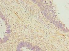 OTUD6B Antibody - Immunohistochemistry of paraffin-embedded human ovarian cancer using antibody at dilution of 1:100.