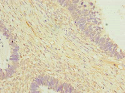 OTUD6B Antibody - Immunohistochemistry of paraffin-embedded human ovarian cancer using OTUD6B Antibody at dilution of 1:100