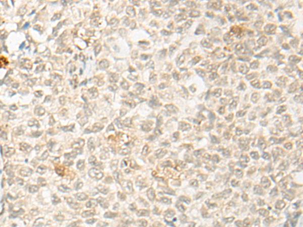 OTX1 Antibody - Immunohistochemistry of paraffin-embedded Human ovarian cancer tissue  using OTX1 Polyclonal Antibody at dilution of 1:30(×200)