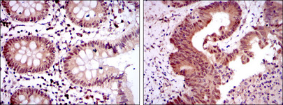 OTX2 Antibody - IHC of paraffin-embedded colon tissues (left) and colon cancer tissues (right) using OTX2 mouse monoclonal antibody with DAB staining.