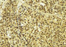 OTX2 Antibody - 1:100 staining human breast carcinoma tissue by IHC-P. The sample was formaldehyde fixed and a heat mediated antigen retrieval step in citrate buffer was performed. The sample was then blocked and incubated with the antibody for 1.5 hours at 22°C. An HRP conjugated goat anti-rabbit antibody was used as the secondary.