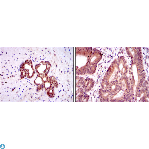 OTX2 Antibody - Immunohistochemistry (IHC) analysis of paraffin-embedded prostate tissues (left) and colon cancer tissues (right) with DAB staining using OTX2 Monoclonal Antibody.