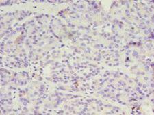 OVCA1 / DPH1 Antibody - Immunohistochemistry of paraffin-embedded human ovarian cancer using antibody at 1:100 dilution.  This image was taken for the unconjugated form of this product. Other forms have not been tested.