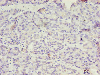 OVCA1 / DPH1 Antibody - Immunohistochemistry of paraffin-embedded human ovarian cancer using DPH1 Antibody at dilution of 1:100