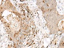OVOL2 Antibody - Immunohistochemistry of paraffin-embedded Human esophagus cancer tissue  using OVOL2 Polyclonal Antibody at dilution of 1:50(×200)