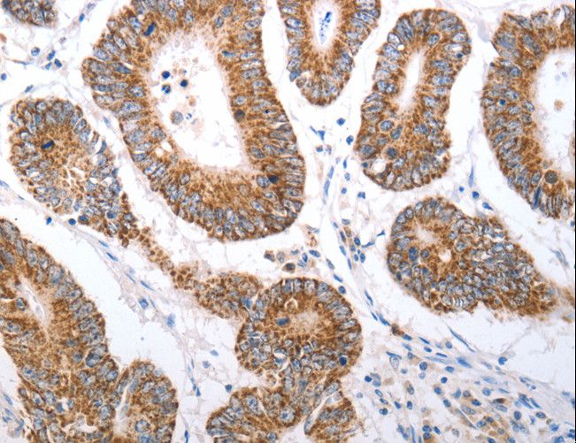 OX1R / Orexin Receptor 1 Antibody - Immunohistochemistry of paraffin-embedded Human liver cancer using HCRTR1 Polyclonal Antibody at dilution of 1:70.
