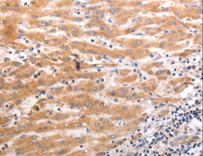 OX1R / Orexin Receptor 1 Antibody - Immunohistochemistry of paraffin-embedded Human liver cancer using HCRTR1 Polyclonal Antibody at dilution of 1:70.