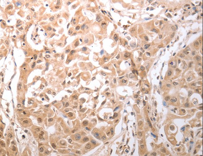 OX1R / Orexin Receptor 1 Antibody - Immunohistochemistry of paraffin-embedded Human lung cancer using HCRTR1 Polyclonal Antibody at dilution of 1:100.