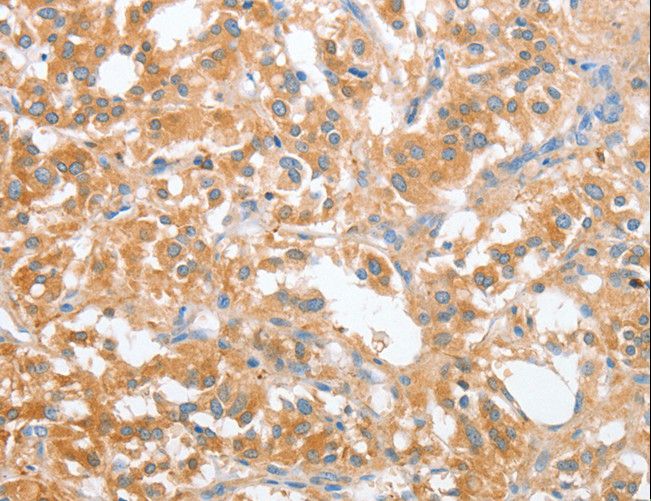 OX2R / Orexin Receptor 2 Antibody - Immunohistochemistry of paraffin-embedded Human thyroid cancer using CD200R1 Polyclonal Antibody at dilution of 1:60.