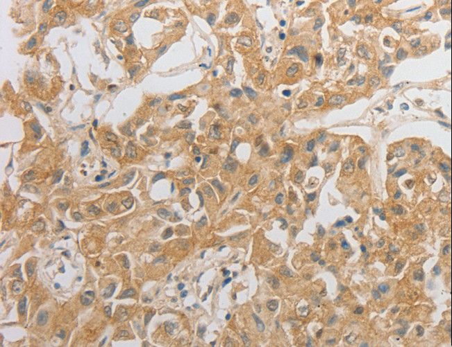 OX2R / Orexin Receptor 2 Antibody - Immunohistochemistry of paraffin-embedded Human ovarian cancer using HCRTR2 Polyclonal Antibody at dilution of 1:50.