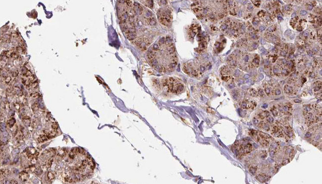 OXA1L / OXA1 Antibody - 1:100 staining human pancreas carcinoma tissue by IHC-P. The sample was formaldehyde fixed and a heat mediated antigen retrieval step in citrate buffer was performed. The sample was then blocked and incubated with the antibody for 1.5 hours at 22°C. An HRP conjugated goat anti-rabbit antibody was used as the secondary.