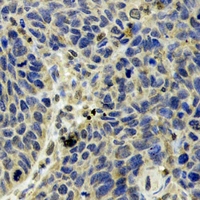 OXCT1 Antibody - Immunohistochemical analysis of SCOT staining in human esophageal cancer formalin fixed paraffin embedded tissue section. The section was pre-treated using heat mediated antigen retrieval with sodium citrate buffer (pH 6.0). The section was then incubated with the antibody at room temperature and detected using an HRP conjugated compact polymer system. DAB was used as the chromogen. The section was then counterstained with hematoxylin and mounted with DPX.