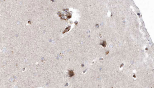 OXCT1 Antibody - 1:100 staining human brain carcinoma tissue by IHC-P. The sample was formaldehyde fixed and a heat mediated antigen retrieval step in citrate buffer was performed. The sample was then blocked and incubated with the antibody for 1.5 hours at 22°C. An HRP conjugated goat anti-rabbit antibody was used as the secondary.