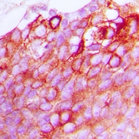 OXER1 Antibody - Immunohistochemical analysis of GPR170 staining in human breast cancer formalin fixed paraffin embedded tissue section. The section was pre-treated using heat mediated antigen retrieval with sodium citrate buffer (pH 6.0). The section was then incubated with the antibody at room temperature and detected using an HRP polymer system. DAB was used as the chromogen. The section was then counterstained with hematoxylin and mounted with DPX.