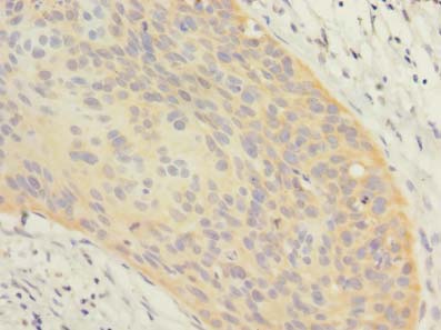 OXR1 Antibody - Immunohistochemistry of paraffin-embedded human cervical cancer using antibody at dilution of 1:100.